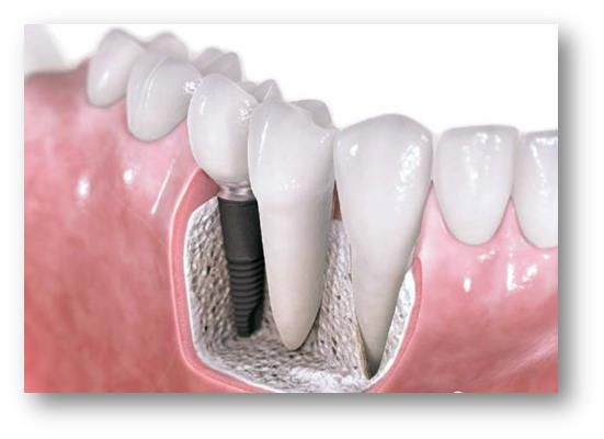解惑种植牙